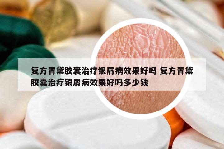 復(fù)方青黛膠囊治療銀屑病效果好嗎 復(fù)方青黛膠囊治療銀屑病效果好嗎多少錢