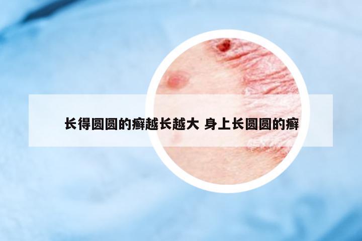 長得圓圓的癬越長越大 身上長圓圓的癬