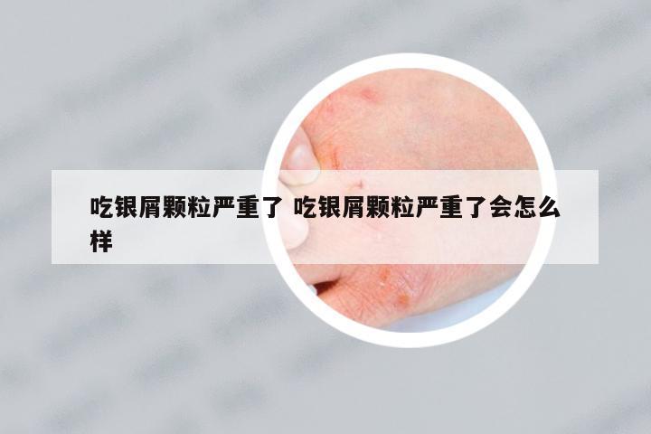 吃銀屑顆粒嚴(yán)重了 吃銀屑顆粒嚴(yán)重了會(huì)怎么樣