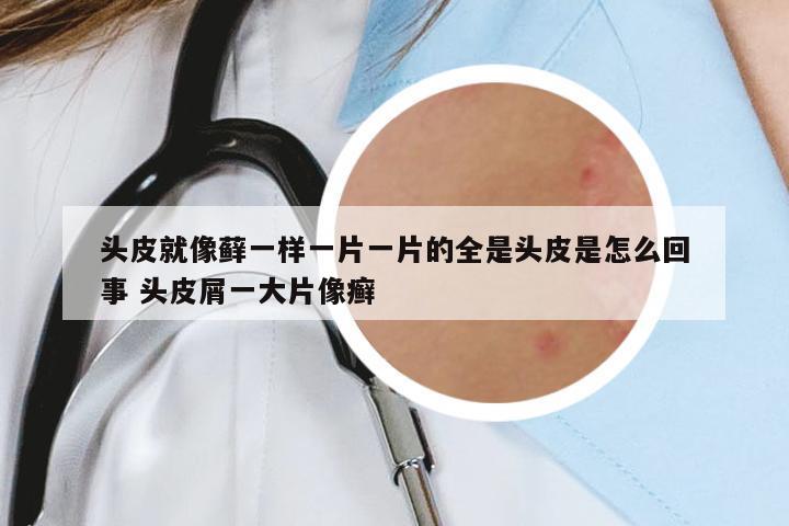 頭皮就像蘚一樣一片一片的全是頭皮是怎么回事 頭皮屑一大片像癬