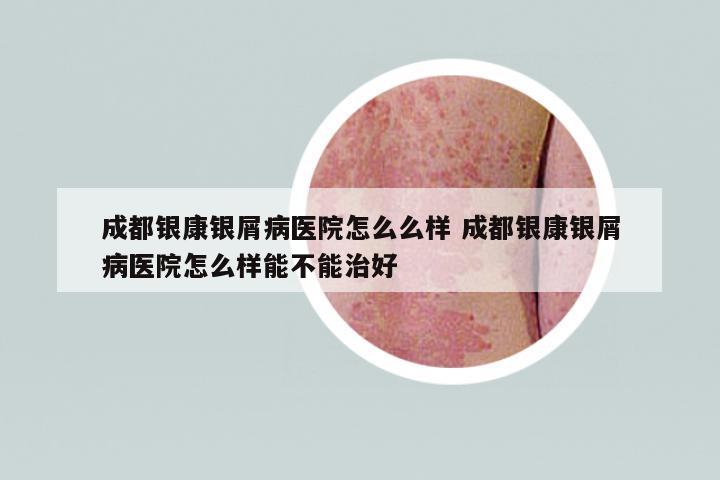 成都銀康銀屑病醫(yī)院怎么么樣 成都銀康銀屑病醫(yī)院怎么樣能不能治好