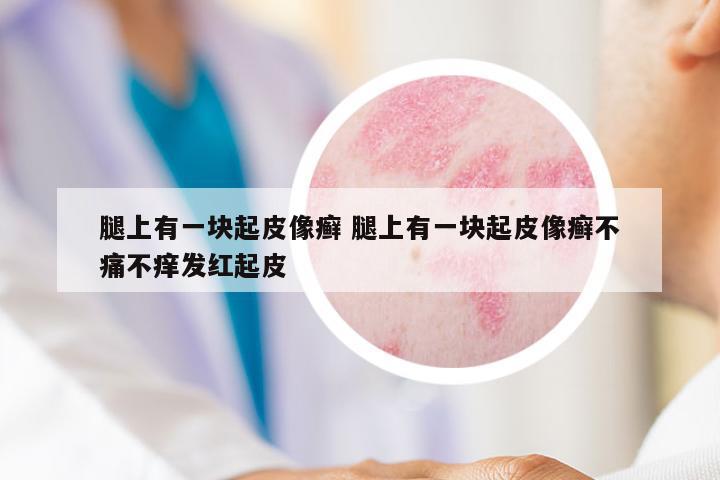 腿上有一塊起皮像癬 腿上有一塊起皮像癬不痛不癢發(fā)紅起皮