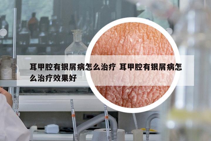耳甲腔有銀屑病怎么治療 耳甲腔有銀屑病怎么治療效果好