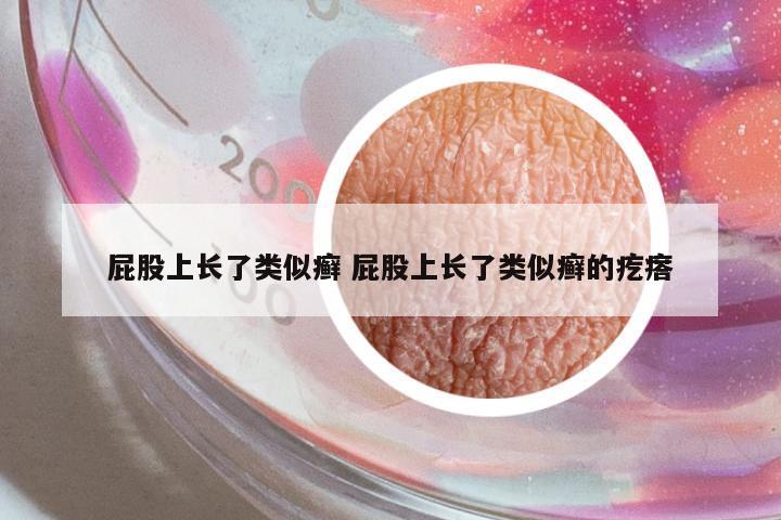 屁股上長了類似癬 屁股上長了類似癬的疙瘩
