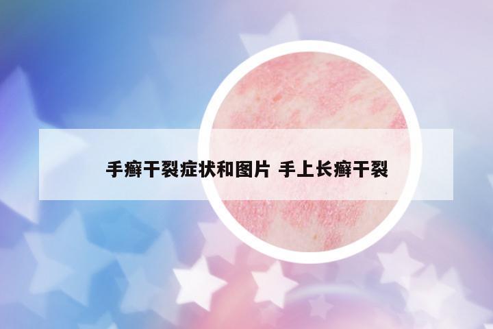 手癬干裂癥狀和圖片 手上長癬干裂