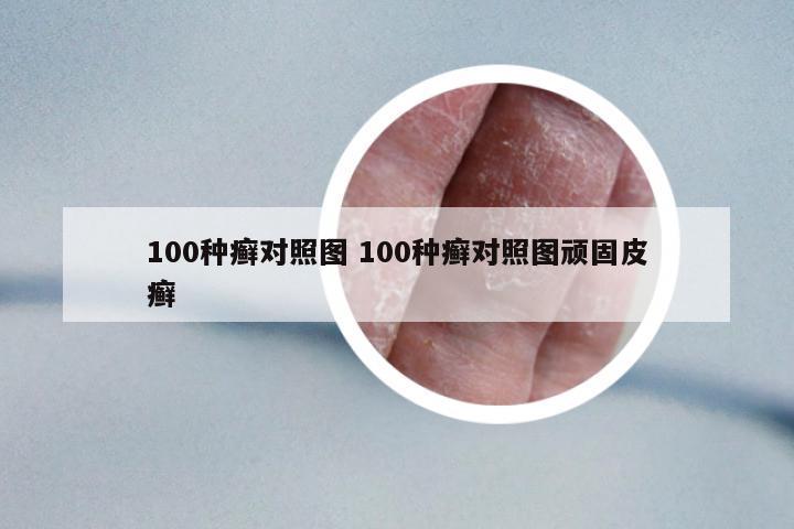 100種癬對照圖 100種癬對照圖頑固皮癬