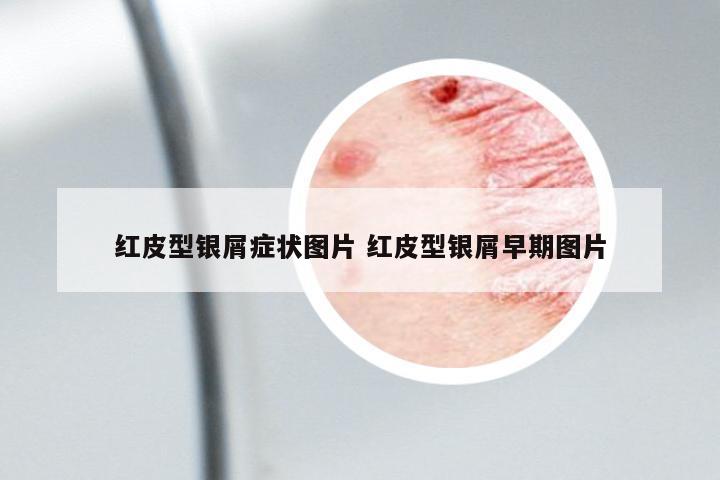 紅皮型銀屑癥狀圖片 紅皮型銀屑早期圖片