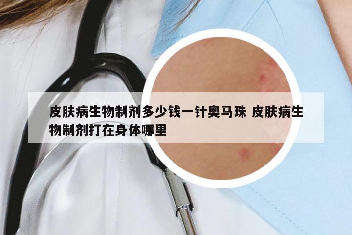 皮膚病生物制劑多少錢一針奧馬珠 皮膚病生物制劑打在身體哪里