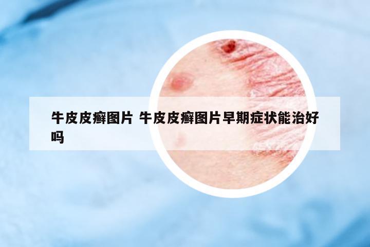 牛皮皮癬圖片 牛皮皮癬圖片早期癥狀能治好嗎