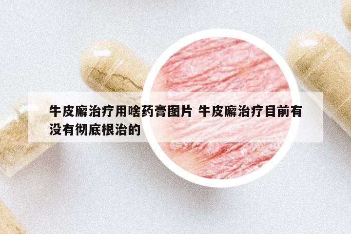 牛皮廨治療用啥藥膏圖片 牛皮廨治療目前有沒(méi)有徹底根治的