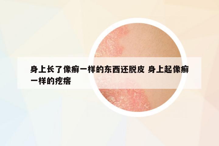 身上長了像癬一樣的東西還脫皮 身上起像癬一樣的疙瘩