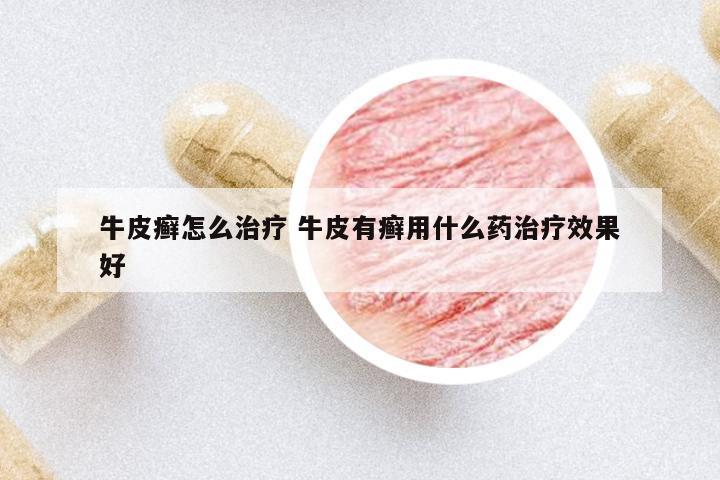 牛皮癬怎么治療 牛皮有癬用什么藥治療效果好