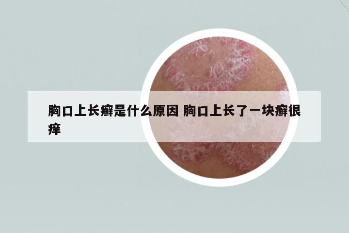 胸口上長癬是什么原因 胸口上長了一塊癬很癢