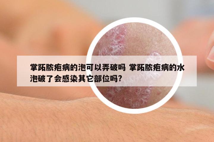 掌跖膿皰病的泡可以弄破嗎 掌跖膿皰病的水泡破了會(huì)感染其它部位嗎?