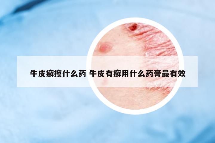 牛皮癬擦什么藥 牛皮有癬用什么藥膏最有效