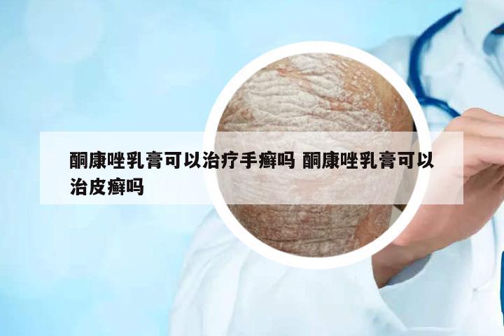 酮康唑乳膏可以治療手癬嗎 酮康唑乳膏可以治皮癬嗎