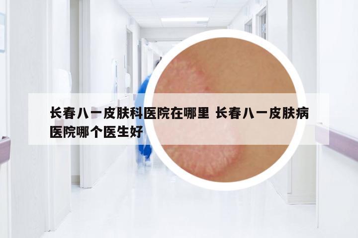 長春八一皮膚科醫(yī)院在哪里 長春八一皮膚病醫(yī)院哪個醫(yī)生好