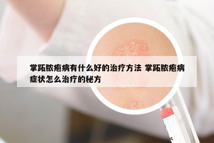 掌跖膿皰病有什么好的治療方法 掌跖膿皰病癥狀怎么治療的秘方