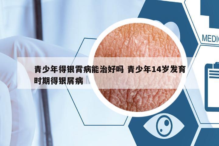 青少年得銀霄病能治好嗎 青少年14歲發(fā)育時期得銀屑病