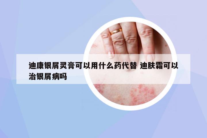 迪康銀屑靈膏可以用什么藥代替 迪膚霜可以治銀屑病嗎