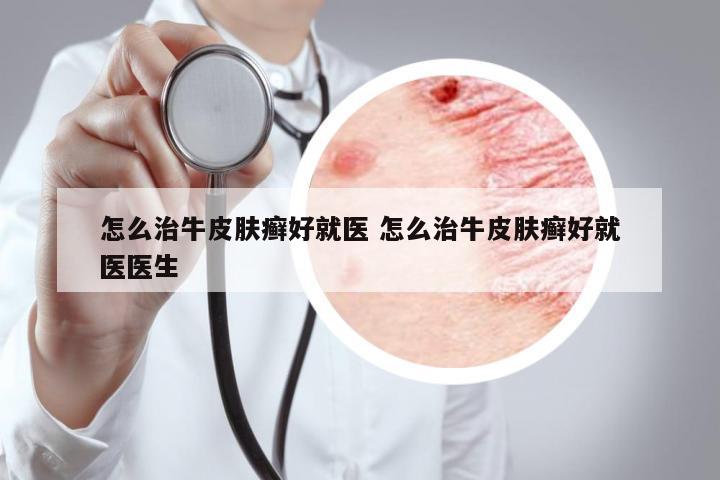 怎么治牛皮膚癬好就醫(yī) 怎么治牛皮膚癬好就醫(yī)醫(yī)生
