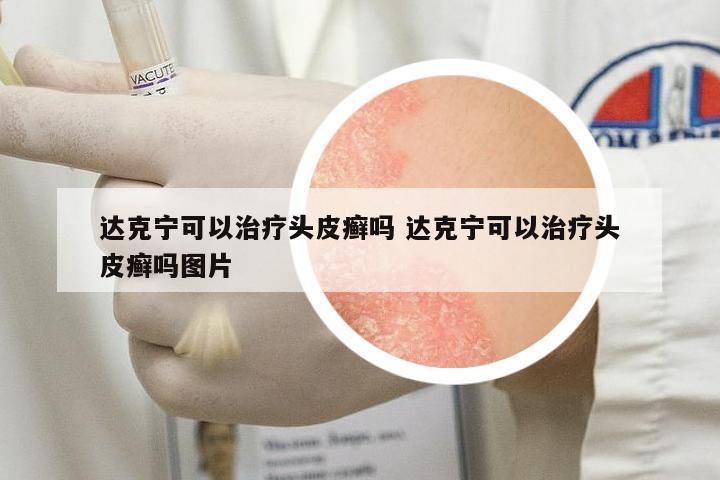 達克寧可以治療頭皮癬嗎 達克寧可以治療頭皮癬嗎圖片
