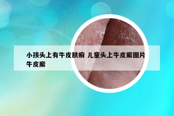 小孩頭上有牛皮膚癬 兒童頭上牛皮廨圖片 牛皮廨