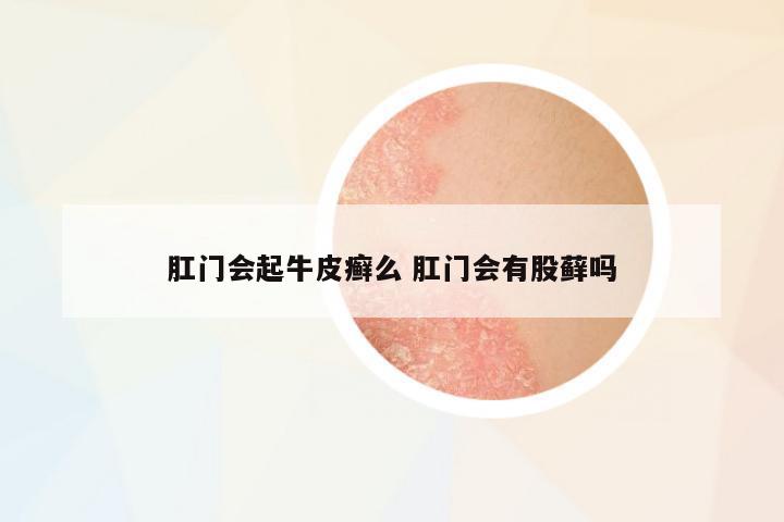 肛門會(huì)起牛皮癬么 肛門會(huì)有股蘚嗎