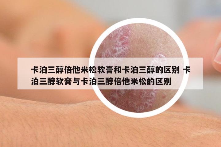 卡泊三醇倍他米松軟膏和卡泊三醇的區(qū)別 卡泊三醇軟膏與卡泊三醇倍他米松的區(qū)別