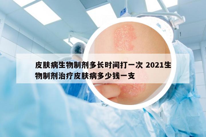 皮膚病生物制劑多長時(shí)間打一次 2021生物制劑治療皮膚病多少錢一支