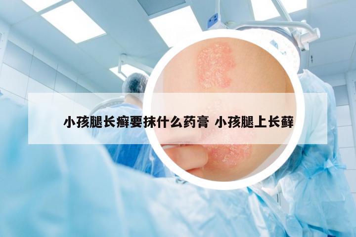 小孩腿長癬要抹什么藥膏 小孩腿上長蘚