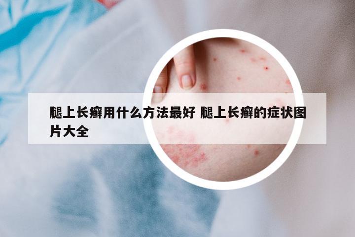 腿上長(zhǎng)癬用什么方法最好 腿上長(zhǎng)癬的癥狀圖片大全