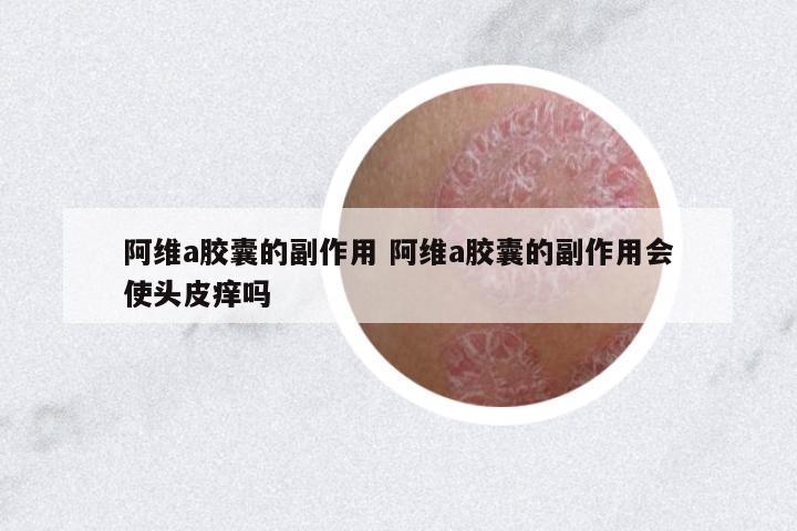 阿維a膠囊的副作用 阿維a膠囊的副作用會使頭皮癢嗎