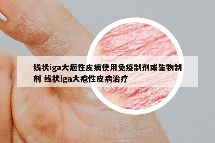 線狀iga大皰性皮病使用免疫制劑或生物制劑 線狀iga大皰性皮病治療