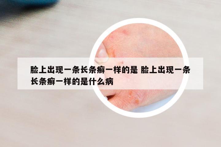 臉上出現(xiàn)一條長條癬一樣的是 臉上出現(xiàn)一條長條癬一樣的是什么病