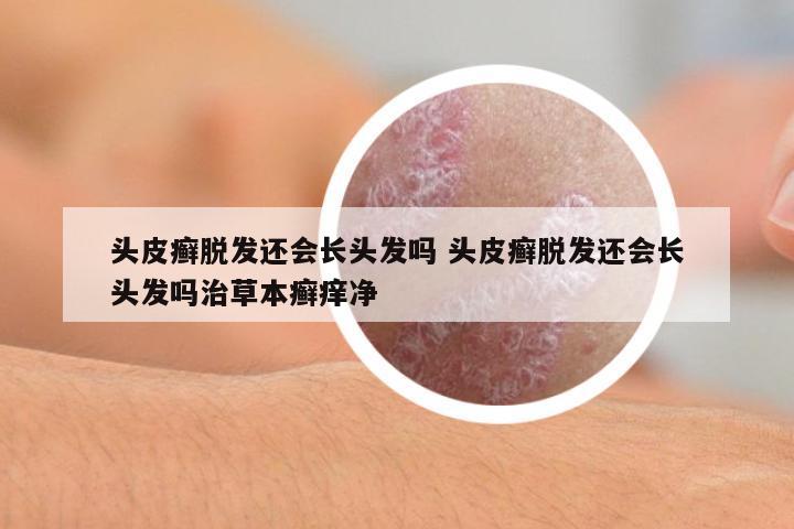 頭皮癬脫發(fā)還會(huì)長(zhǎng)頭發(fā)嗎 頭皮癬脫發(fā)還會(huì)長(zhǎng)頭發(fā)嗎治草本癬癢凈