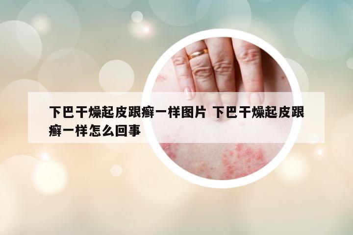 下巴干燥起皮跟癬一樣圖片 下巴干燥起皮跟癬一樣怎么回事