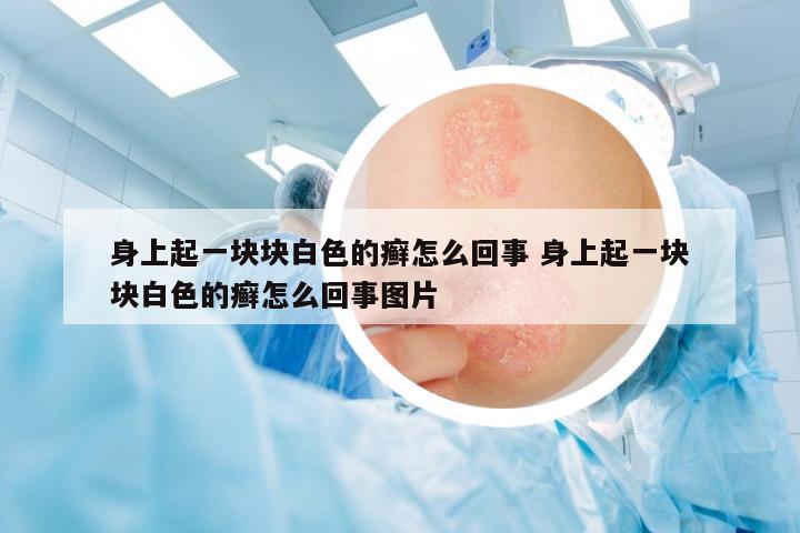 身上起一塊塊白色的癬怎么回事 身上起一塊塊白色的癬怎么回事圖片
