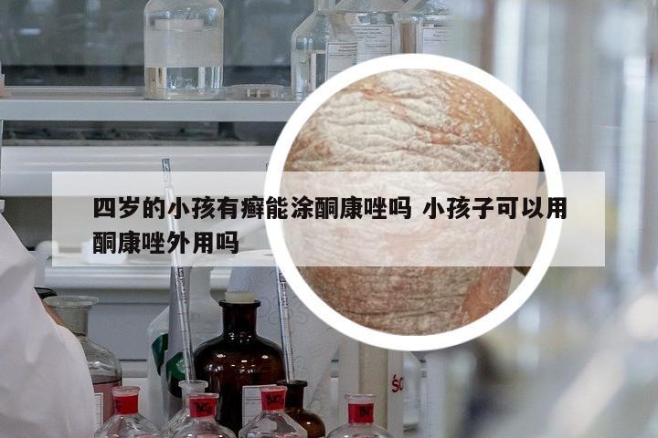 四歲的小孩有癬能涂酮康唑嗎 小孩子可以用酮康唑外用嗎
