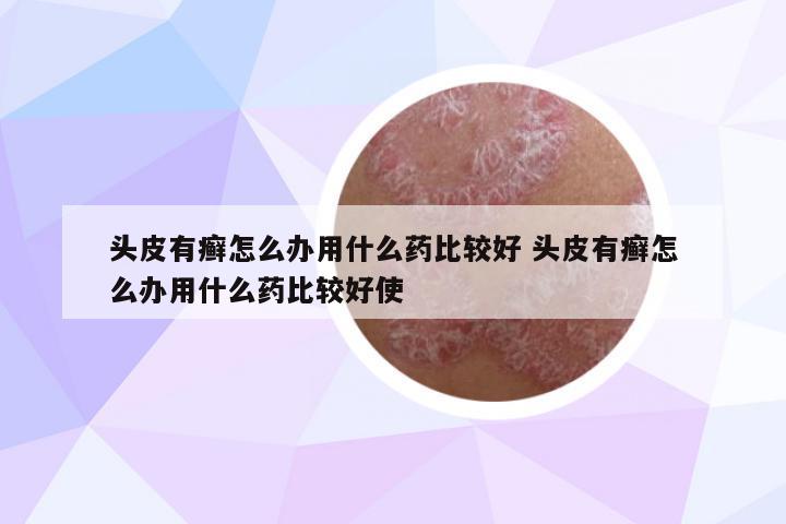 頭皮有癬怎么辦用什么藥比較好 頭皮有癬怎么辦用什么藥比較好使