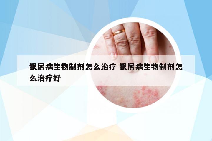 銀屑病生物制劑怎么治療 銀屑病生物制劑怎么治療好