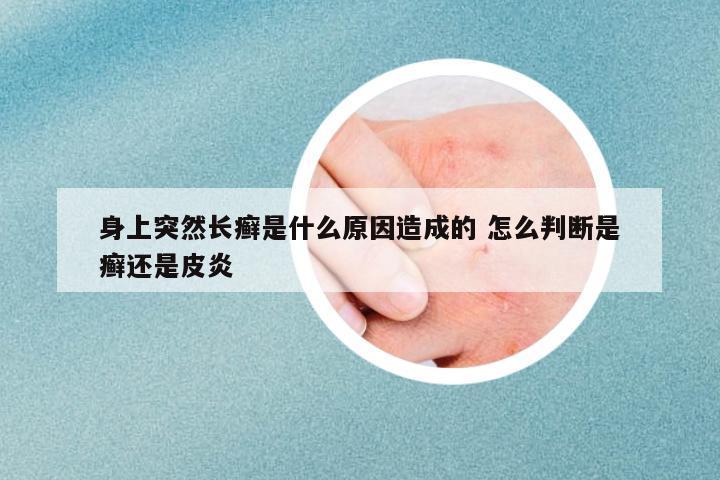 身上突然長癬是什么原因造成的 怎么判斷是癬還是皮炎