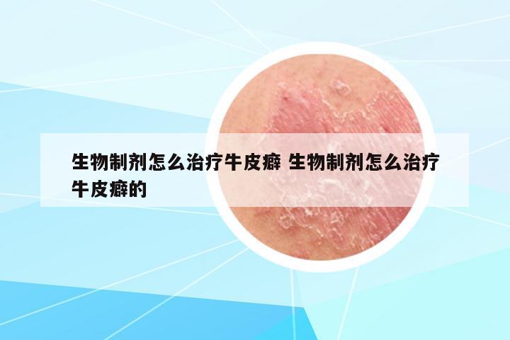 生物制劑怎么治療牛皮癖 生物制劑怎么治療牛皮癖的