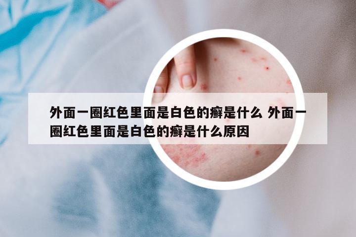 外面一圈紅色里面是白色的癬是什么 外面一圈紅色里面是白色的癬是什么原因