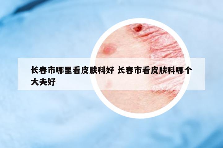 長春市哪里看皮膚科好 長春市看皮膚科哪個大夫好