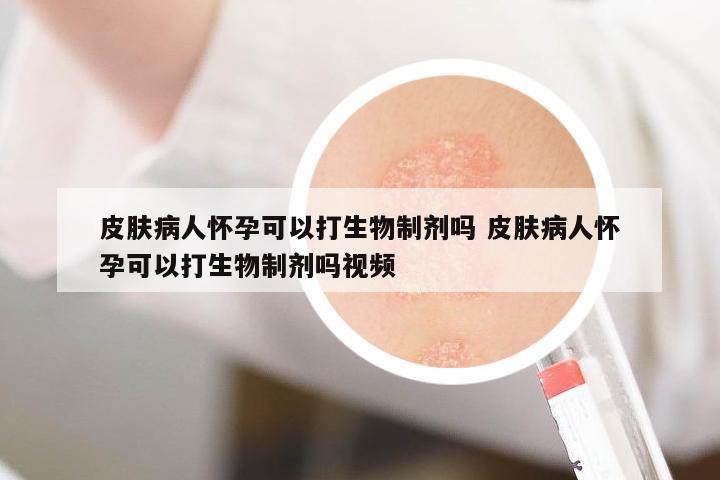 皮膚病人懷孕可以打生物制劑嗎 皮膚病人懷孕可以打生物制劑嗎視頻