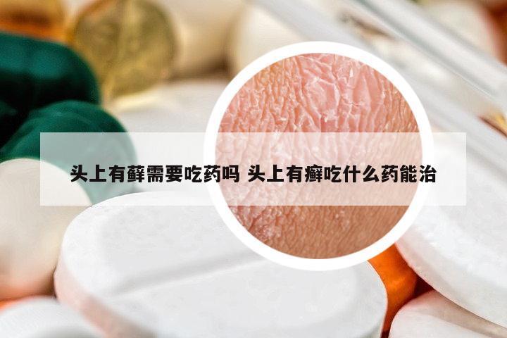 頭上有蘚需要吃藥嗎 頭上有癬吃什么藥能治