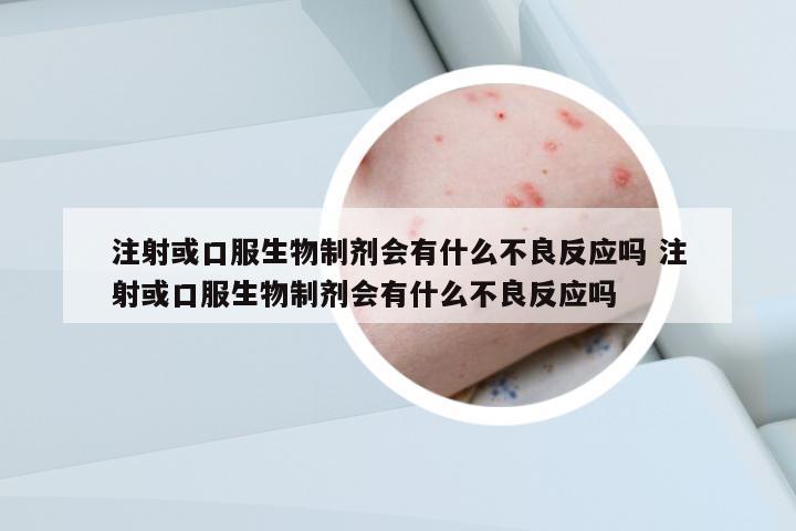 注射或口服生物制劑會(huì)有什么不良反應(yīng)嗎 注射或口服生物制劑會(huì)有什么不良反應(yīng)嗎