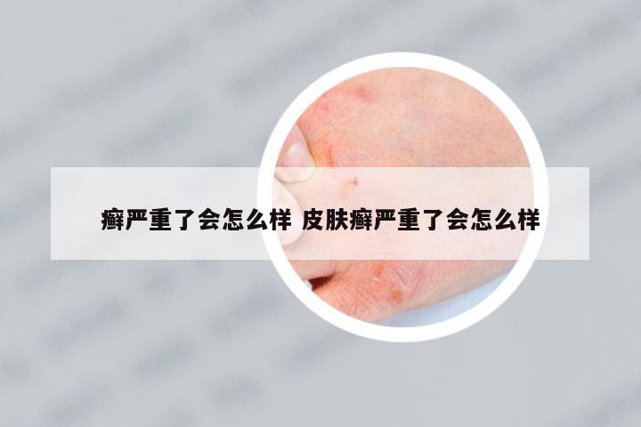 癬嚴(yán)重了會(huì)怎么樣 皮膚癬嚴(yán)重了會(huì)怎么樣