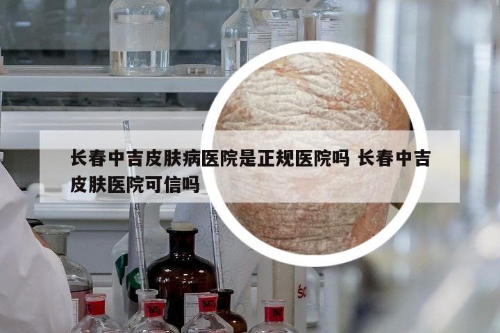 長春中吉皮膚病醫(yī)院是正規(guī)醫(yī)院嗎 長春中吉皮膚醫(yī)院可信嗎